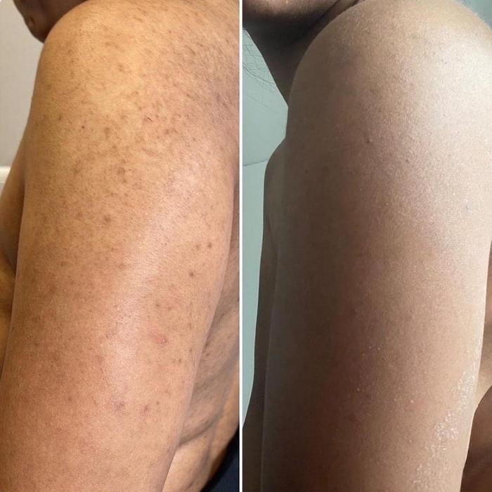 Bilder Silvia Jann Kosmetik und podologische Fußpflege-Praxis-Microneedling RF-Hifu