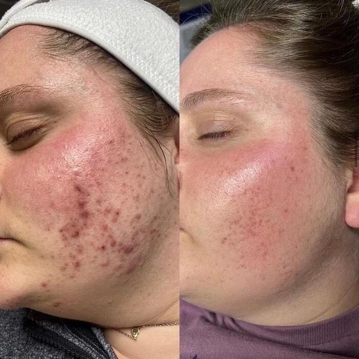 Bilder Silvia Jann Kosmetik und podologische Fußpflege-Praxis-Microneedling RF-Hifu