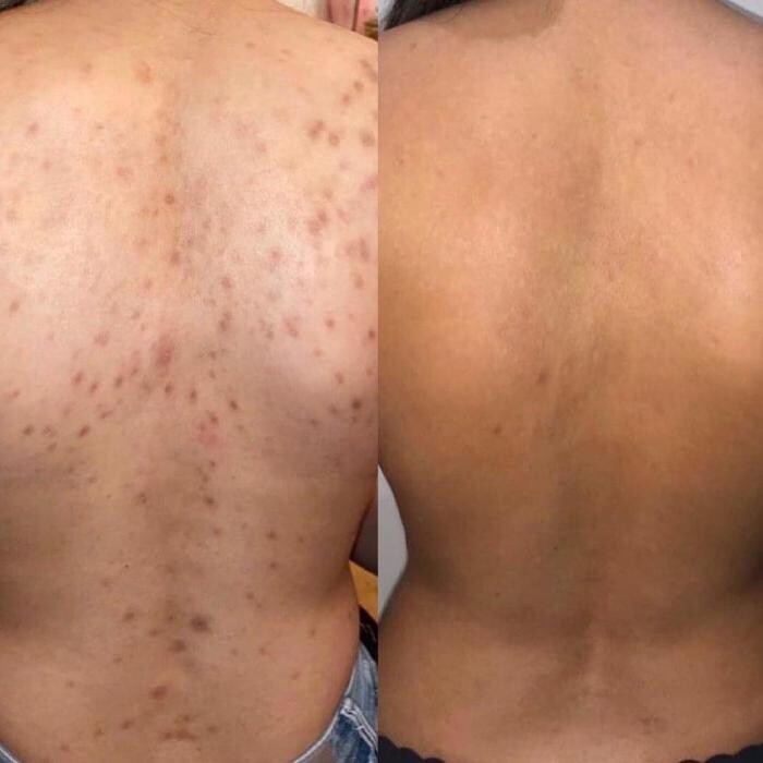 Bilder Silvia Jann Kosmetik und podologische Fußpflege-Praxis-Microneedling RF-Hifu