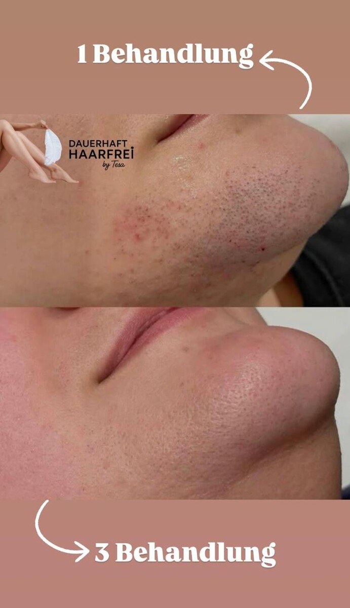 Bilder Dauerhaft Haarfrei by Tesa