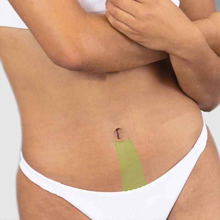 Images Results Laser Clinic Airport West