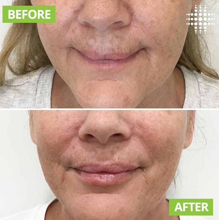 Images Results Laser Clinic Melbourne CBD