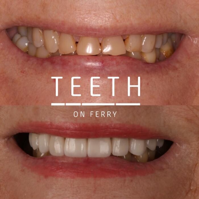 Images Teeth on Ferry