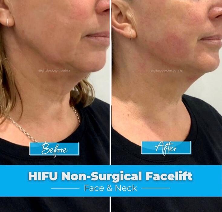 Images Elite Body Contouring Hornsby