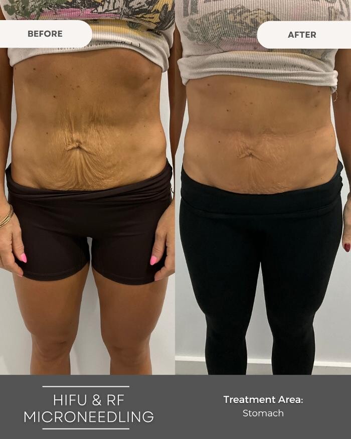 Images Elite Body Contouring Hornsby