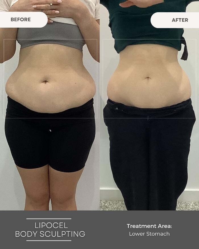 Images Elite Body Contouring Erina