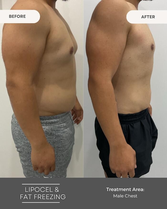 Images Elite Body Contouring Erina