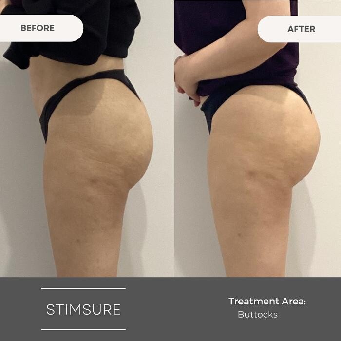 Images Elite Body Contouring Erina