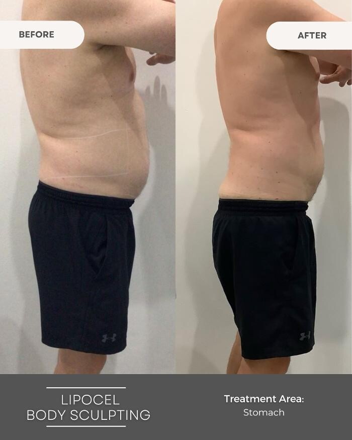 Images Elite Body Contouring Erina