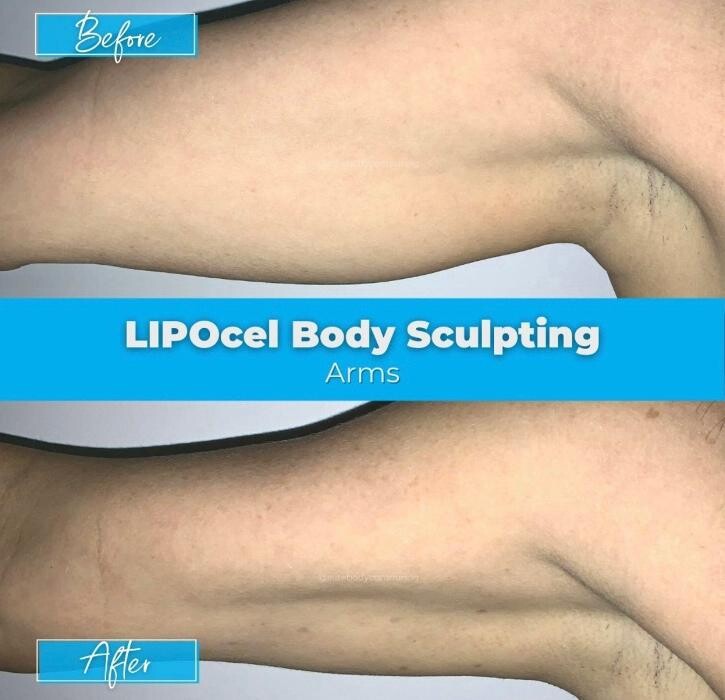 Images Elite Body Contouring Erina