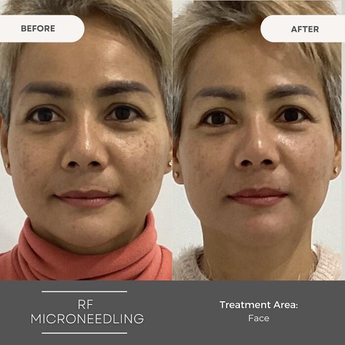 Images Elite Body Contouring Erina
