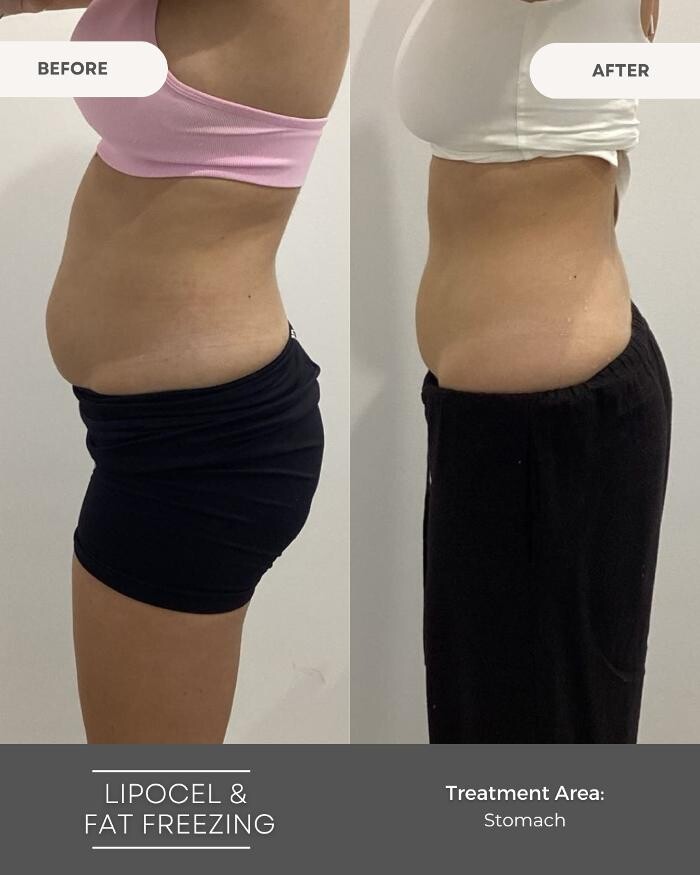 Images Elite Body Contouring Erina