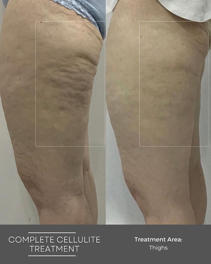 Images Elite Body Contouring Erina