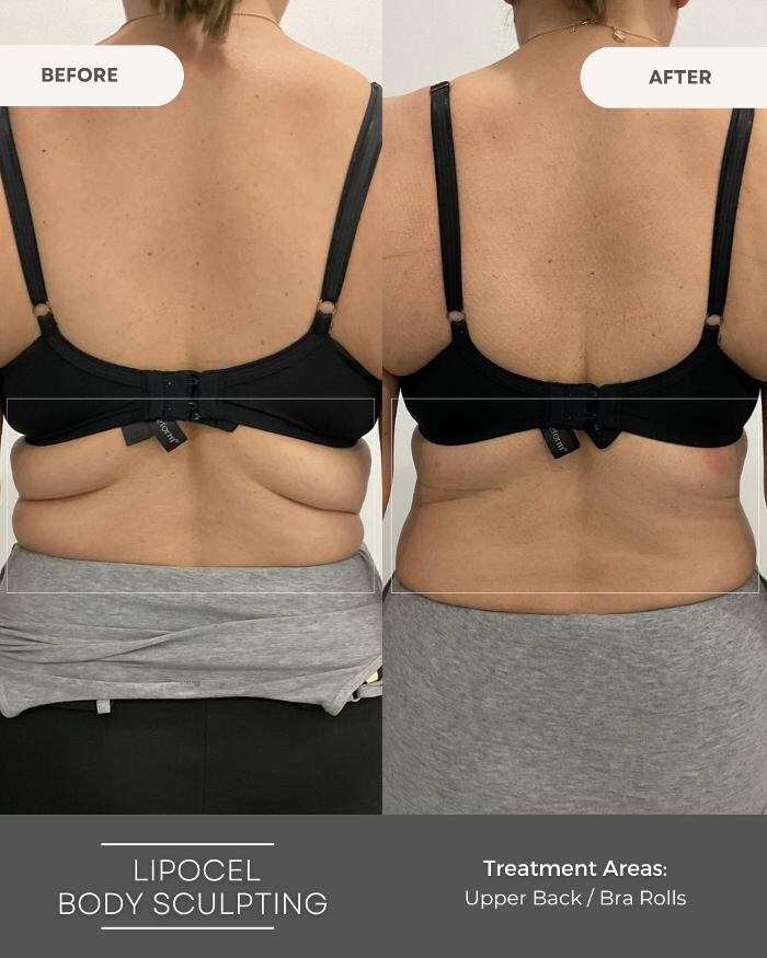 Images Elite Body Contouring Erina