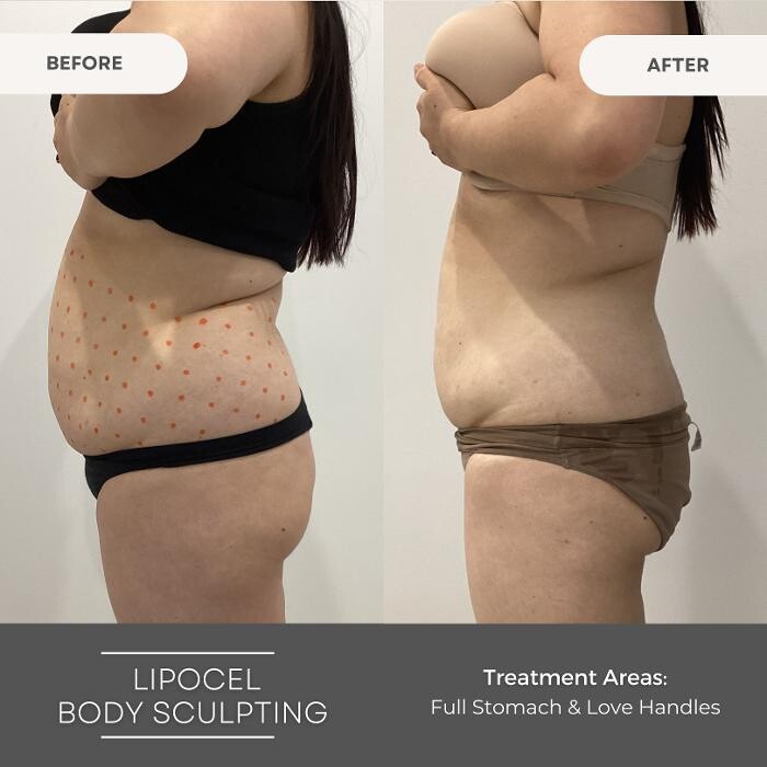 Images Elite Body Contouring Erina