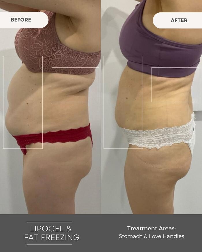 Images Elite Body Contouring Erina