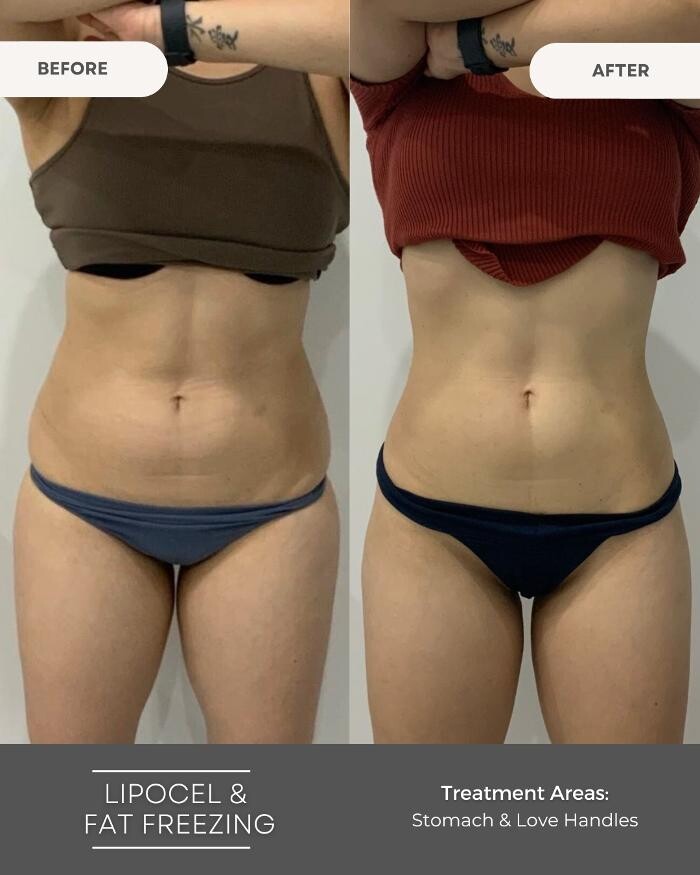 Images Elite Body Contouring Erina