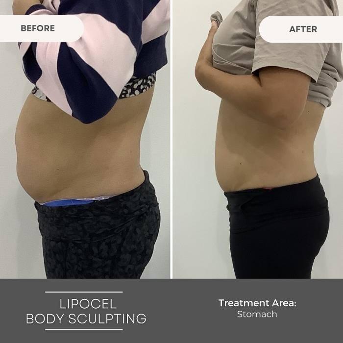 Images Elite Body Contouring Erina
