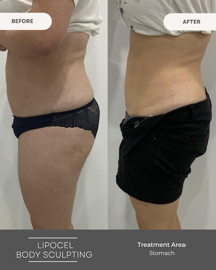 Images Elite Body Contouring Erina