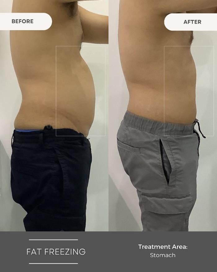 Images Elite Body Contouring Chatswood