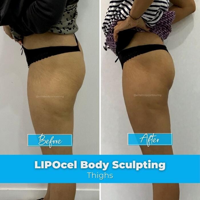 Images Elite Body Contouring Chatswood