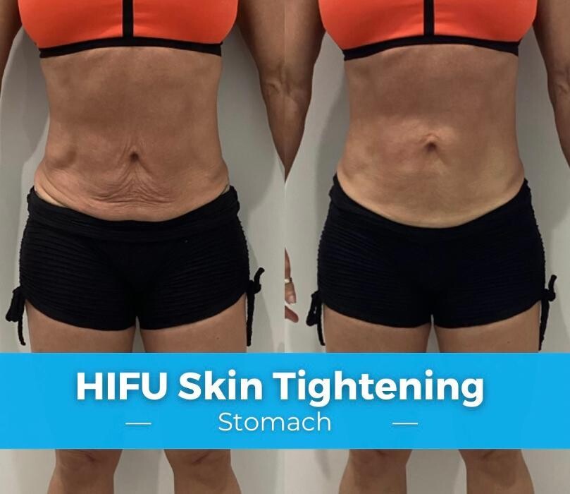 Images Elite Body Contouring Chatswood