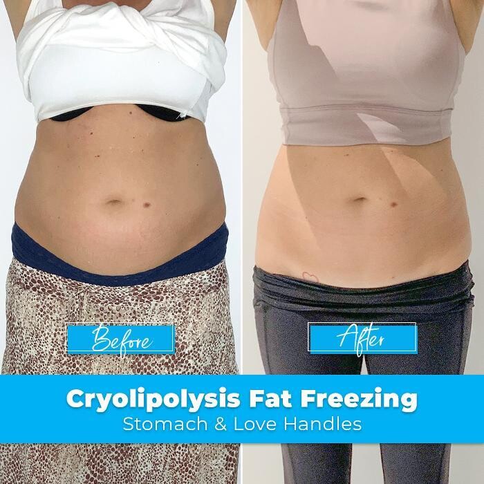 Images Elite Body Contouring Chatswood