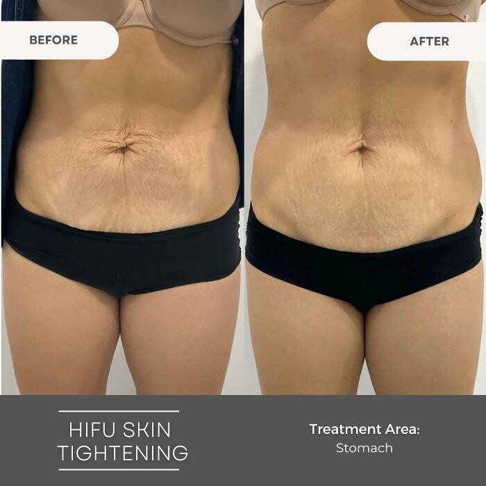 Images Elite Body Contouring Parramatta