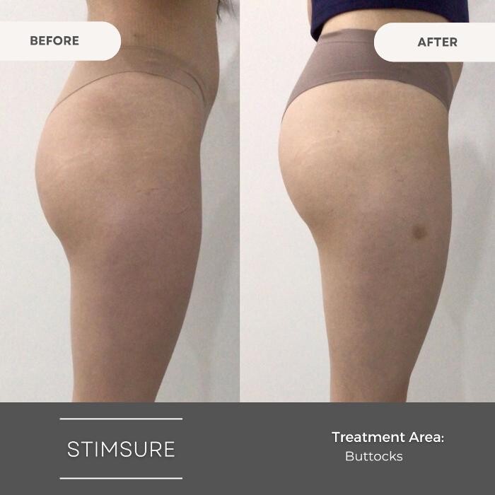 Images Elite Body Contouring Parramatta