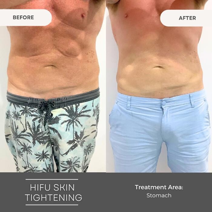 Images Elite Body Contouring Parramatta