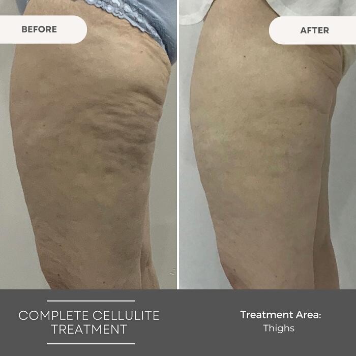 Images Elite Body Contouring Parramatta