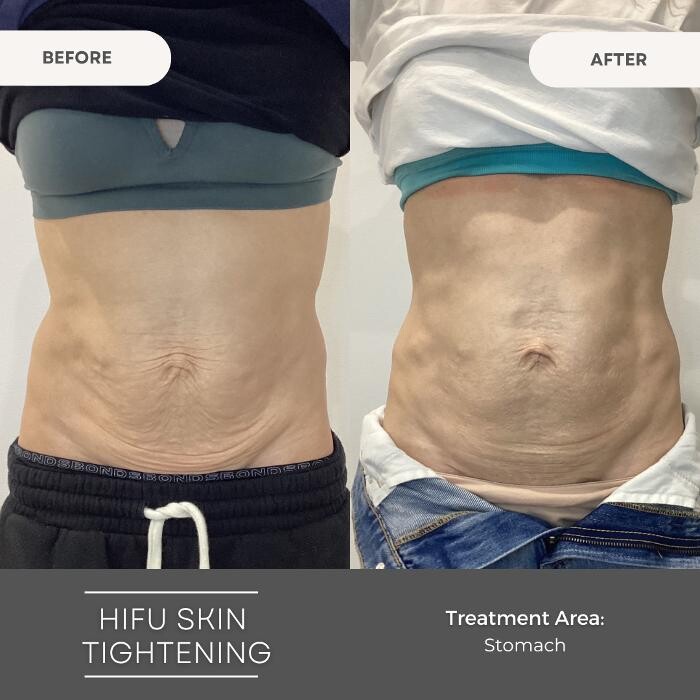 Images Elite Body Contouring Parramatta