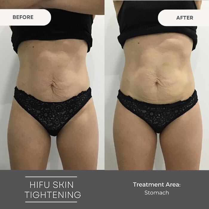Images Elite Body Contouring Parramatta