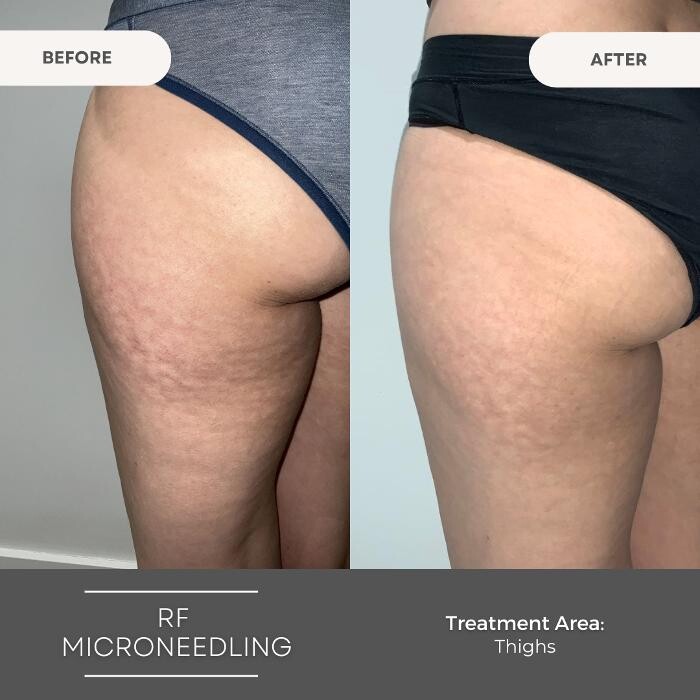 Images Elite Body Contouring Parramatta