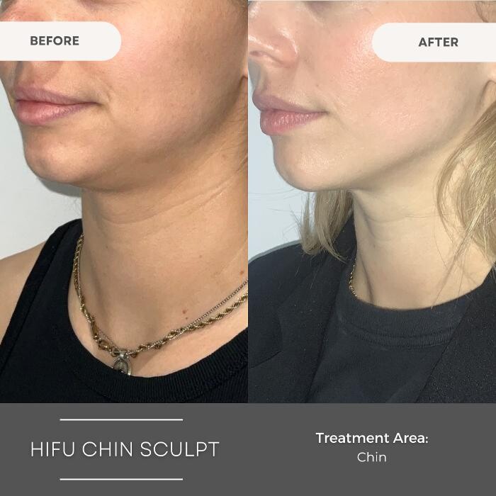 Images Elite Body Contouring Parramatta