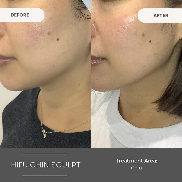 Images Elite Body Contouring Parramatta