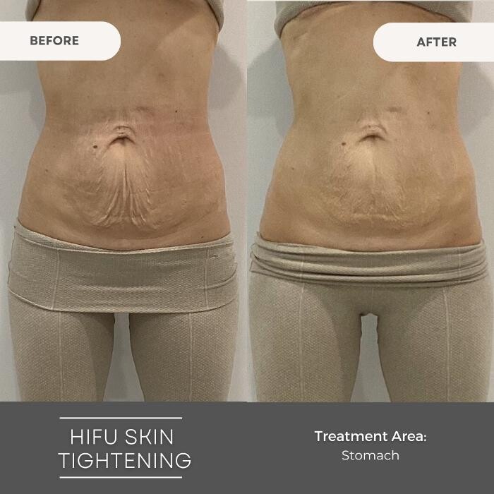 Images Elite Body Contouring Parramatta