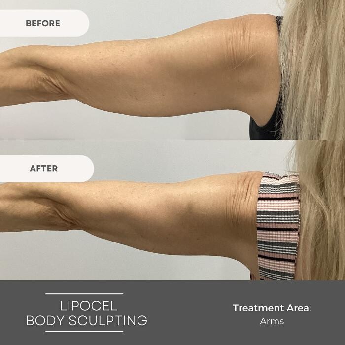 Images Elite Body Contouring Parramatta