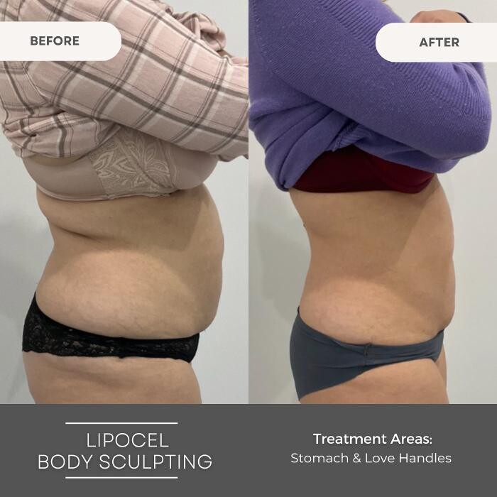 Images Elite Body Contouring Parramatta