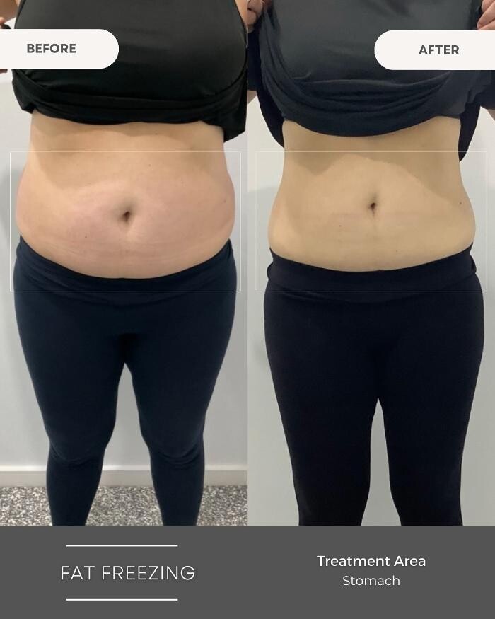 Images Elite Body Contouring Parramatta