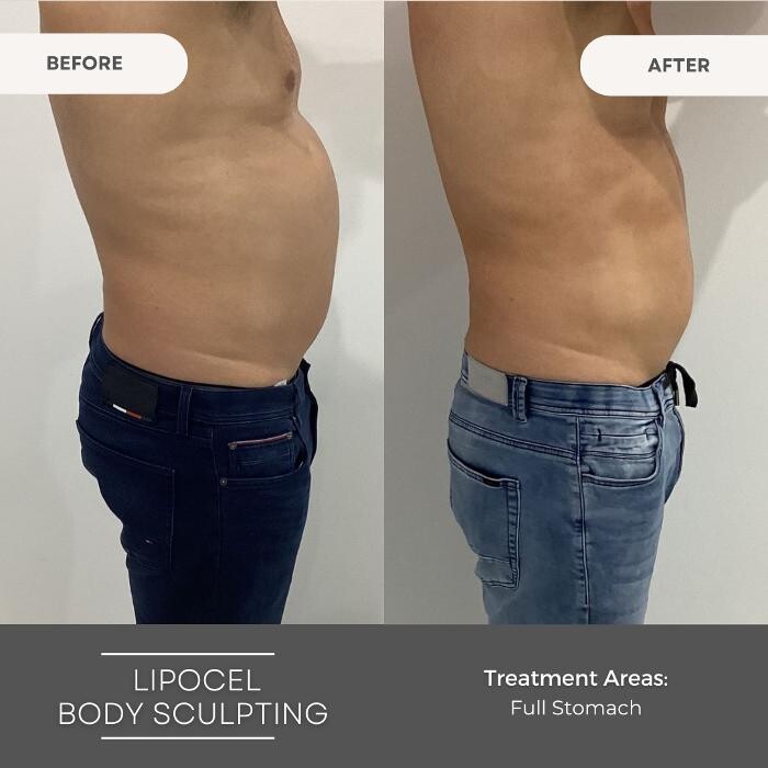 Images Elite Body Contouring Parramatta