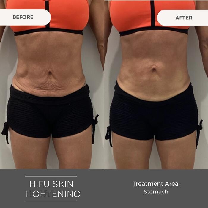 Images Elite Body Contouring Parramatta