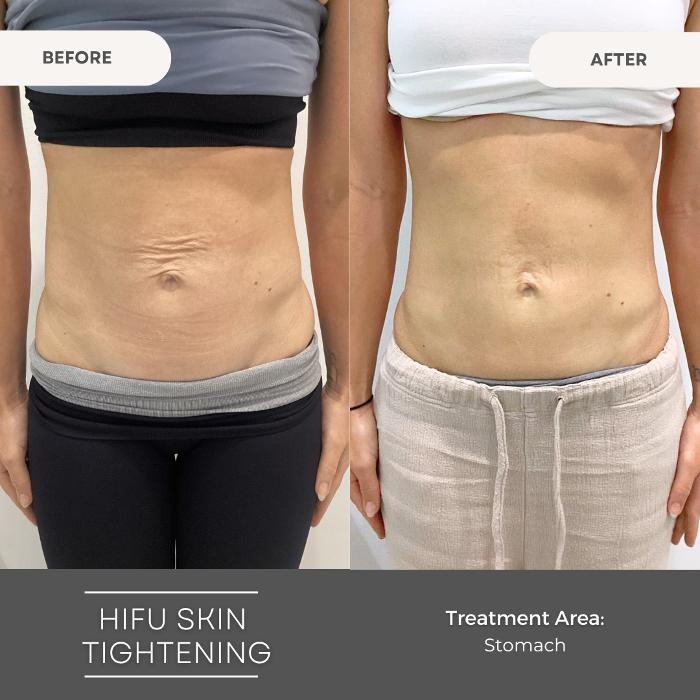 Images Elite Body Contouring Parramatta