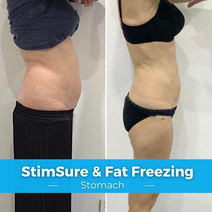 Images Elite Body Contouring Hurstville