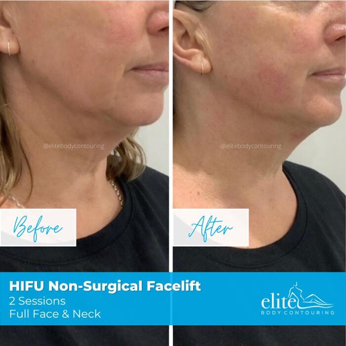 Images Elite Body Contouring Hurstville