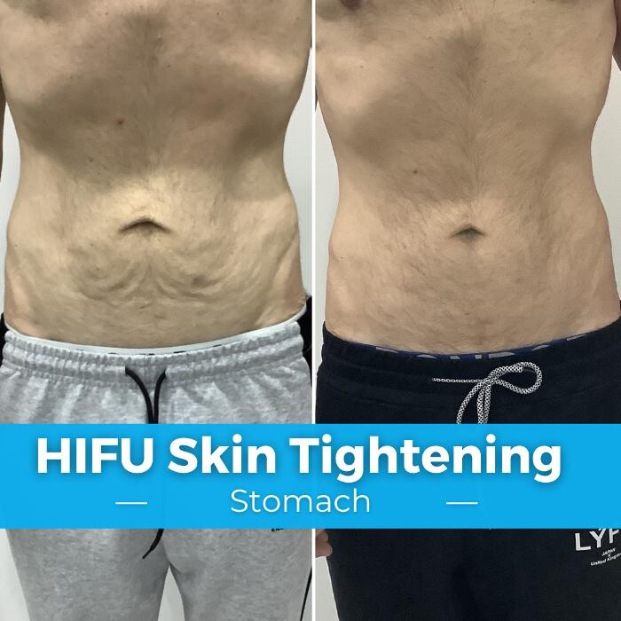 Images Elite Body Contouring Hurstville