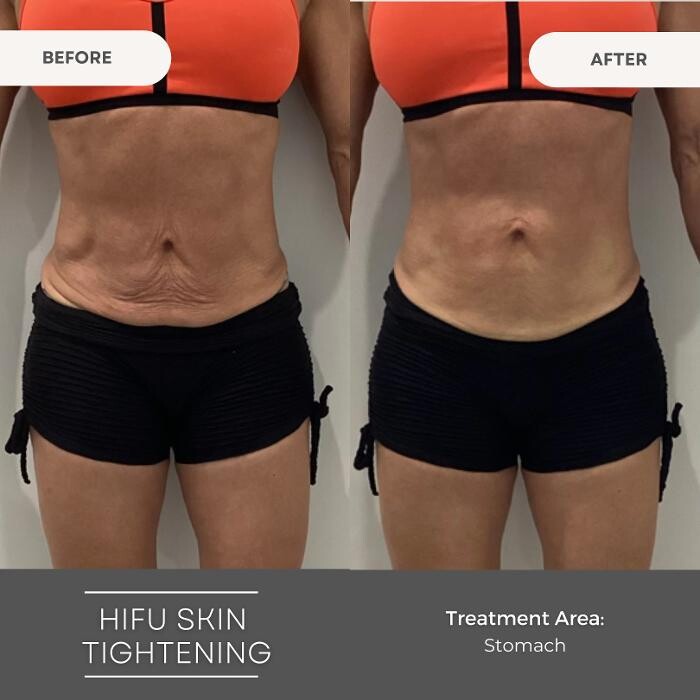 Images Elite Body Contouring Bankstown