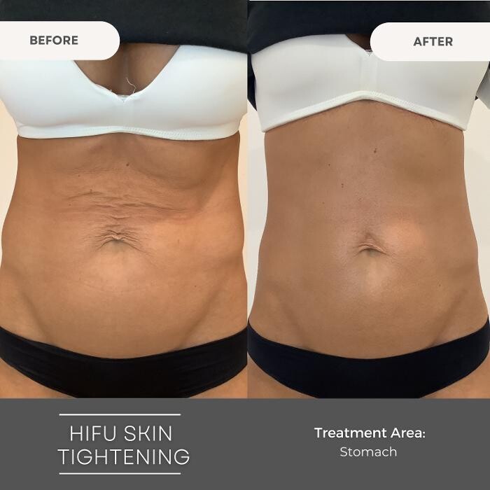 Images Elite Body Contouring Bankstown