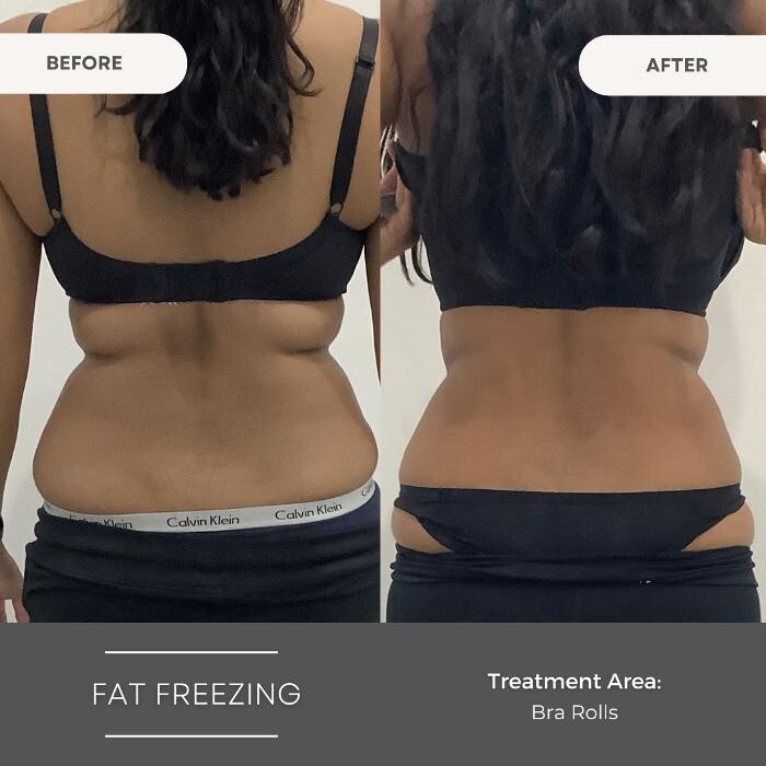 Images Elite Body Contouring Bankstown