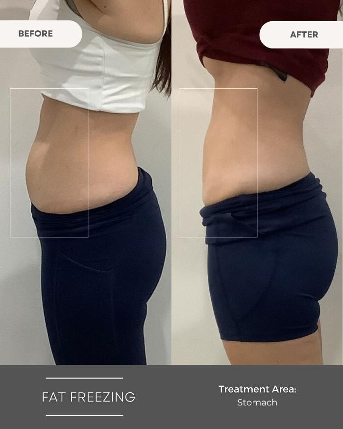 Images Elite Body Contouring Bankstown